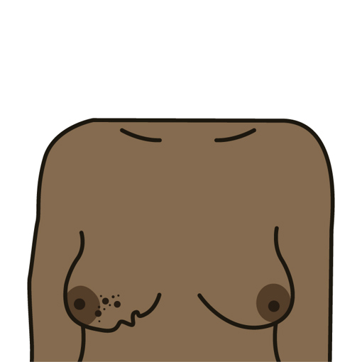 A change to the skin, such as puckering or dimpling 