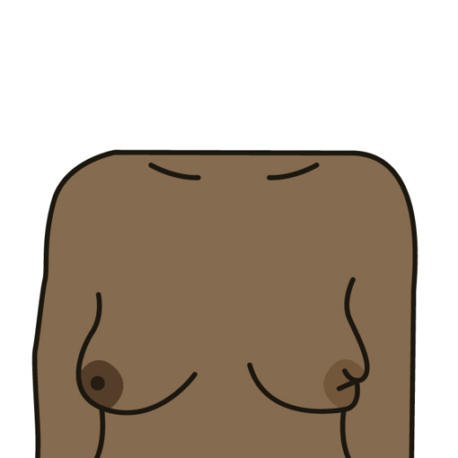 A nipple change, for example it has become pulled in (inverted) 